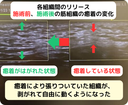 最新首の後ろ癒着改善エコー画面